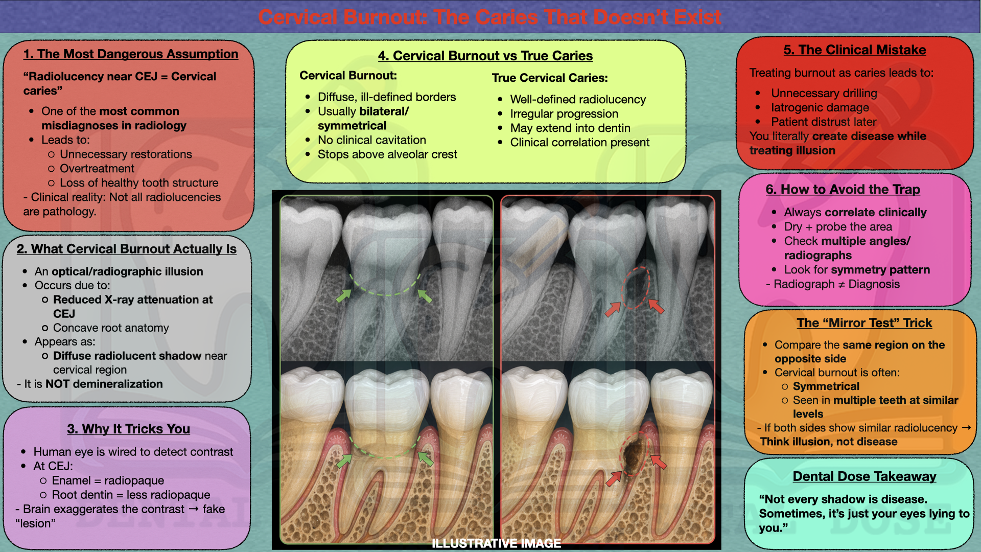 dental dose infographic explaining cervical burnout vs cervical caries including radiographic features symmetry differences and how to avoid misdiagnosis in dental radiology